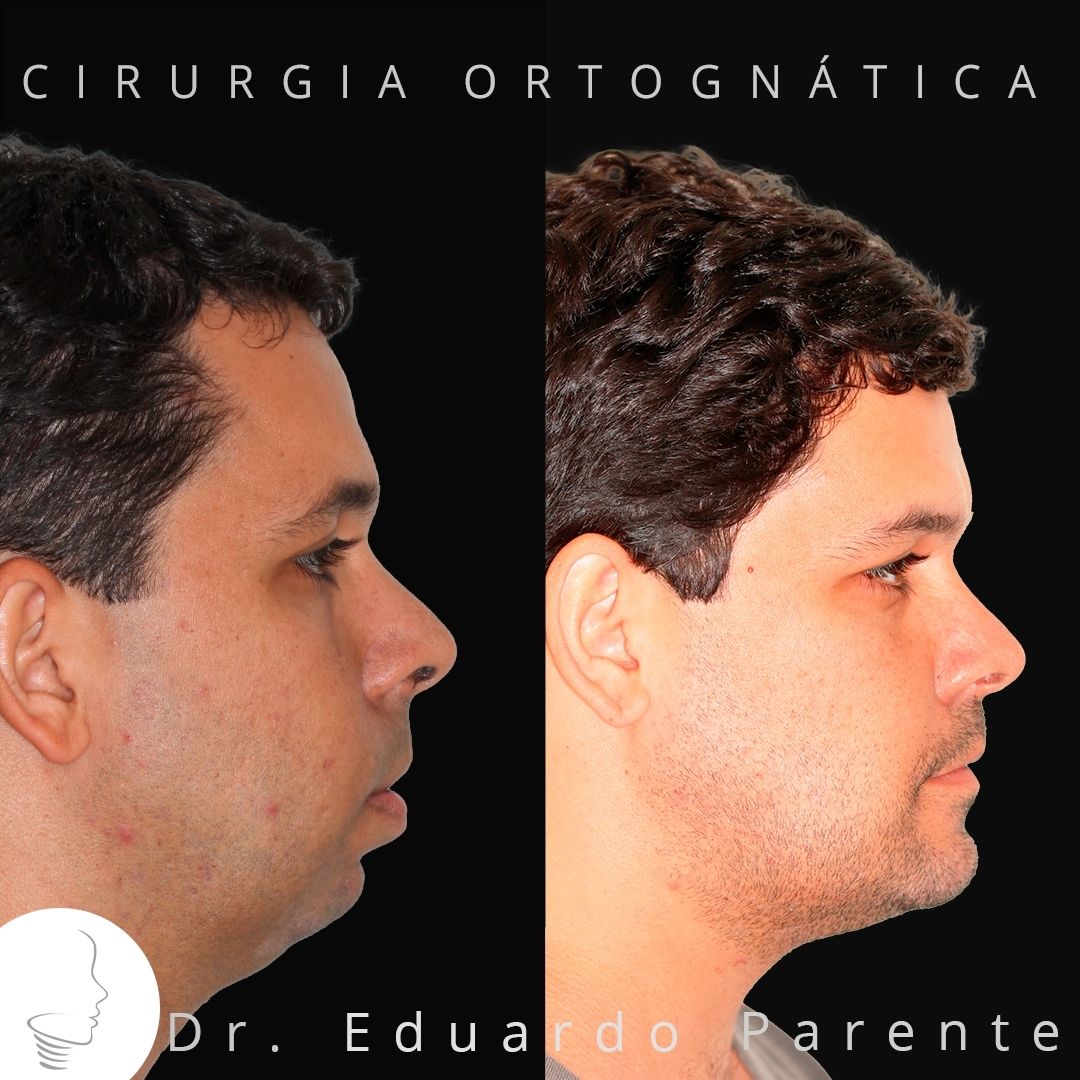 Excesso mandibular - Deficiência maxilar - Classe III - Dra