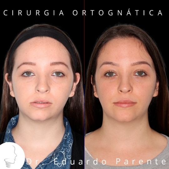 Cirurgia ortognática: antes e depois da cirurgia maxilar