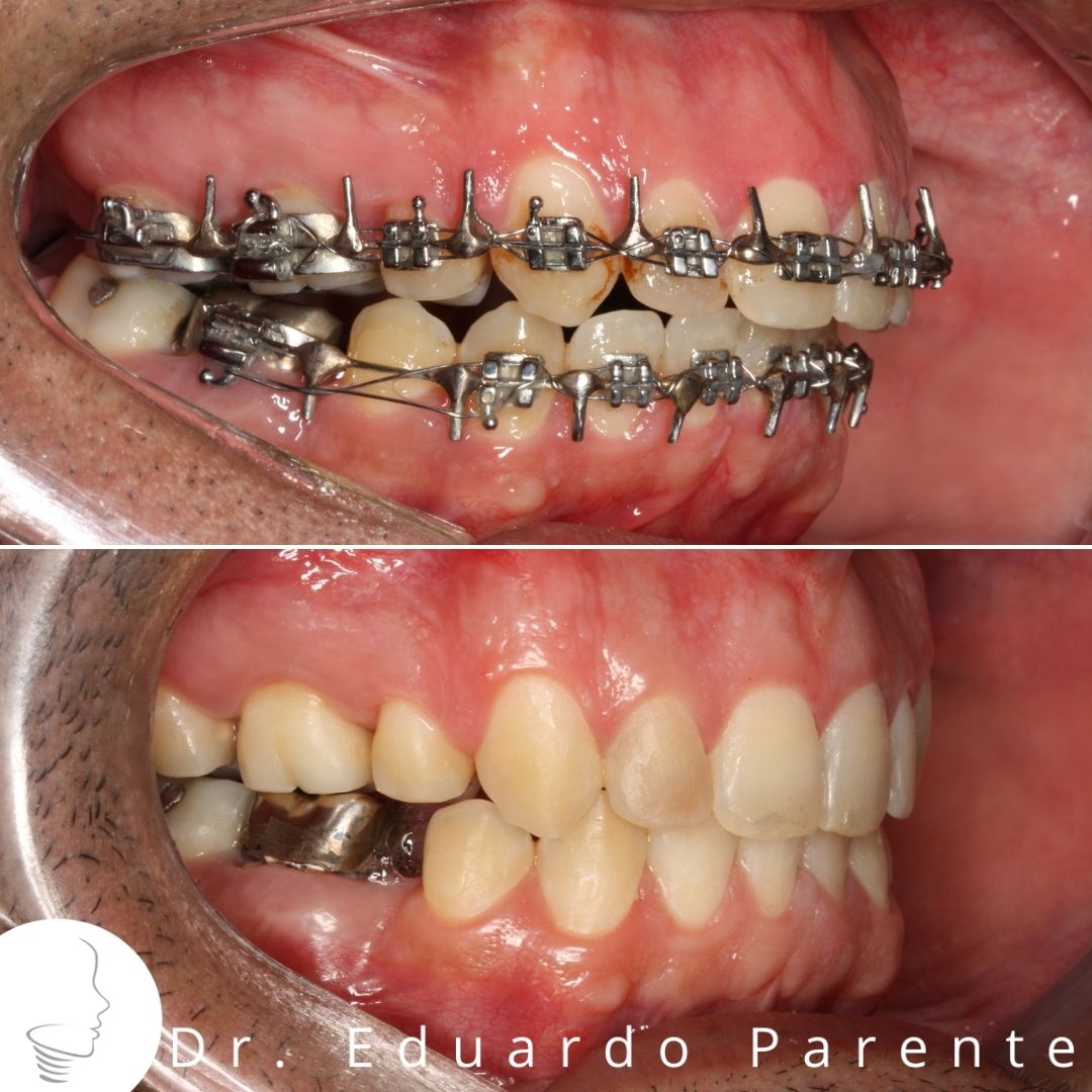 Excesso mandibular - Deficiência maxilar - Classe III - Dra